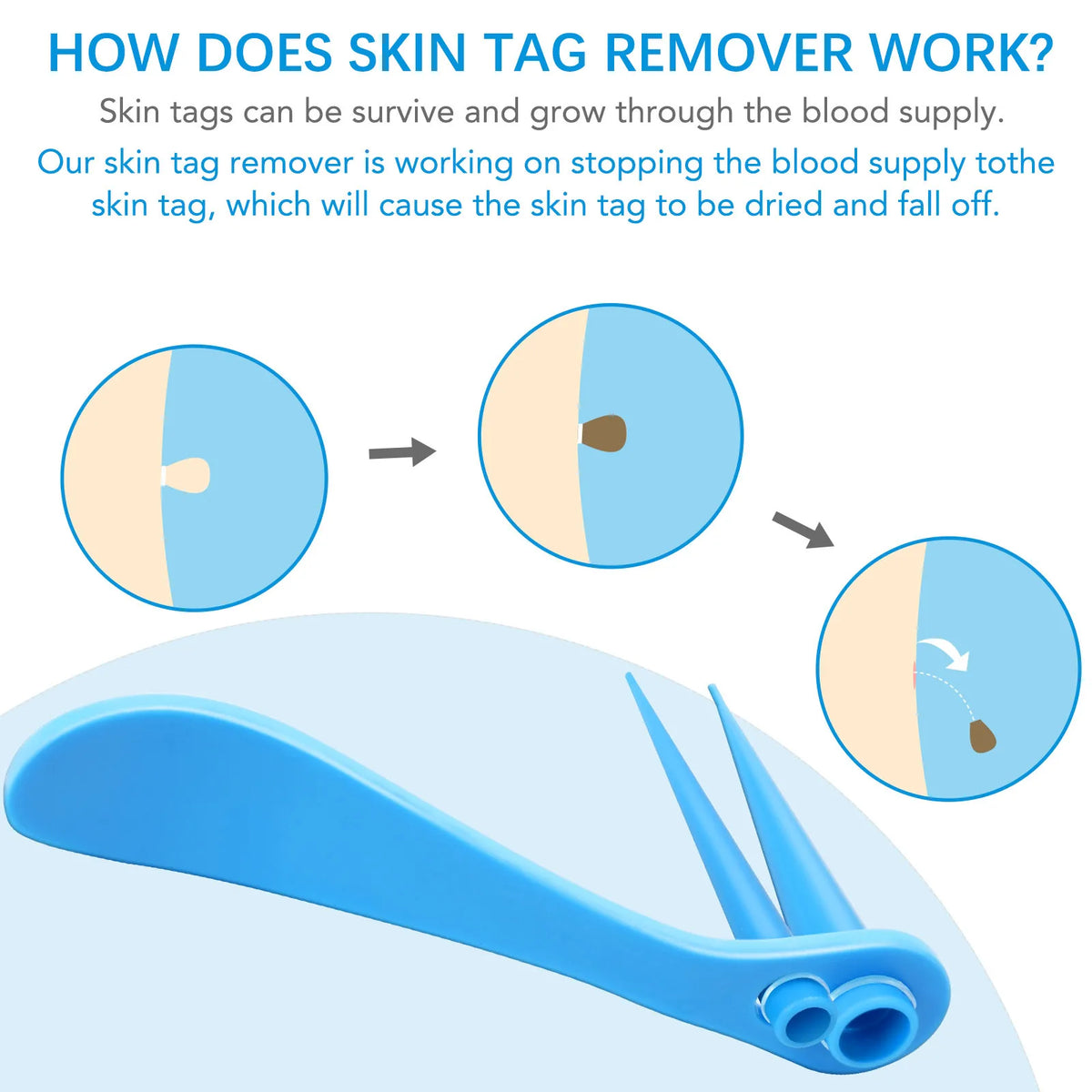 Skin Tag Removal Mole Wart Removal Facial Mole Wart Microstrip Tag Removal Kit Automatic Mole Remover Tool with Cleansing Swabs