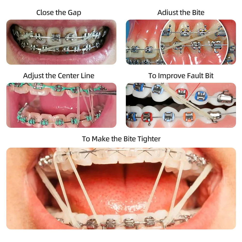 TJdent 5000Pcs/Box Dental Orthodontic Elastics Rubber Bands Zoo Pack Latex Braces Ligation Ring 3.5OZ Dentistry Material