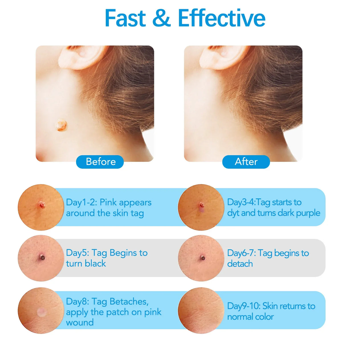 Skin Tag Removal Mole Wart Removal Facial Mole Wart Microstrip Tag Removal Kit Automatic Mole Remover Tool with Cleansing Swabs
