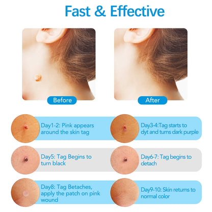 Skin Tag Removal Mole Wart Removal Facial Mole Wart Microstrip Tag Removal Kit Automatic Mole Remover Tool with Cleansing Swabs
