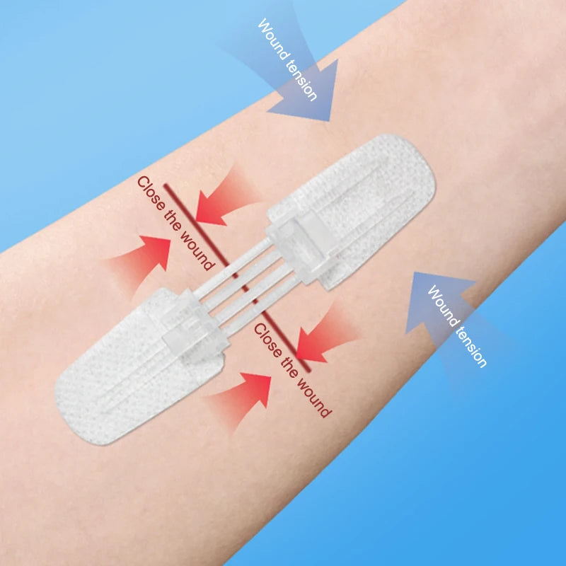 Zipper Band-aid Painless Wound Closure Patch Suture-free Wound Dressing Patches Zip Suture Reducer Band Aid Outdoor Portable