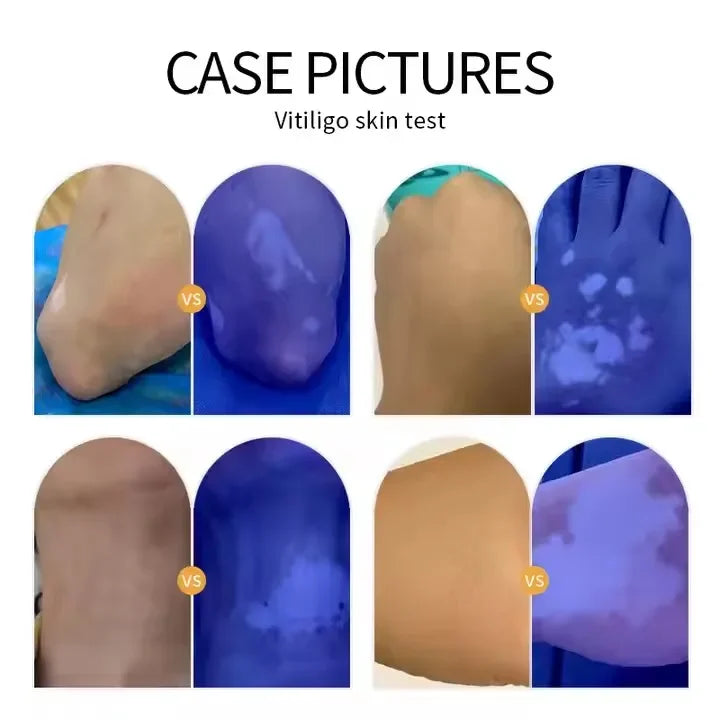 NEW Woods Lamp Skin Analyzer Portable Facial Salon Beauty Analyzer UV Lamp Wood Dermatology for Analyzing Testing Examination