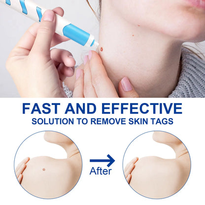 Home Use Painless Safe Skin Tag Mole Wart Spot Removal Equipment for Smooth Skin Wart Remover Eyelid Lifting Acne Treatment Pen