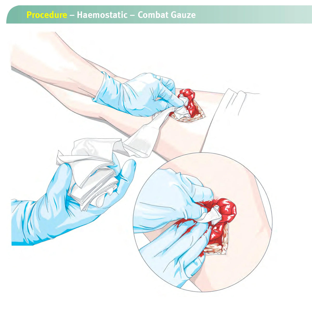 Hemostatic Kaolin Gauze Combat Emergency Trauma Z-Fold Soluble For Ifak Tactical First Aid Kit Medical Wound Dressing